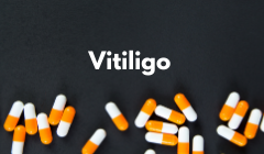 vitiligo