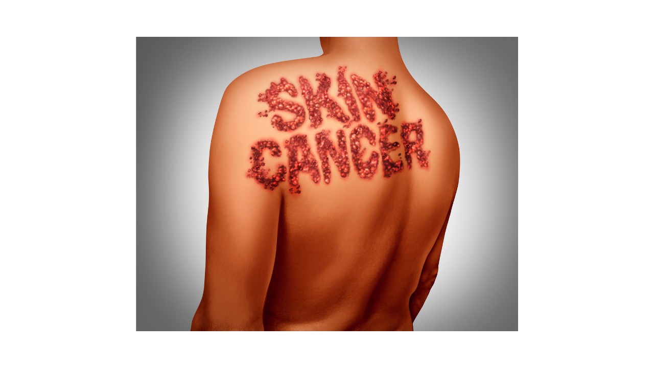 What is Skin Cancer?