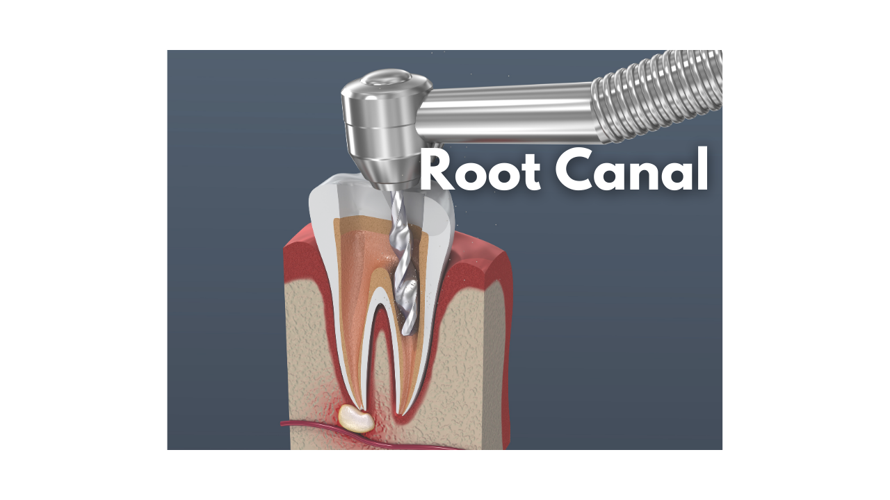 What is root canal treatment?